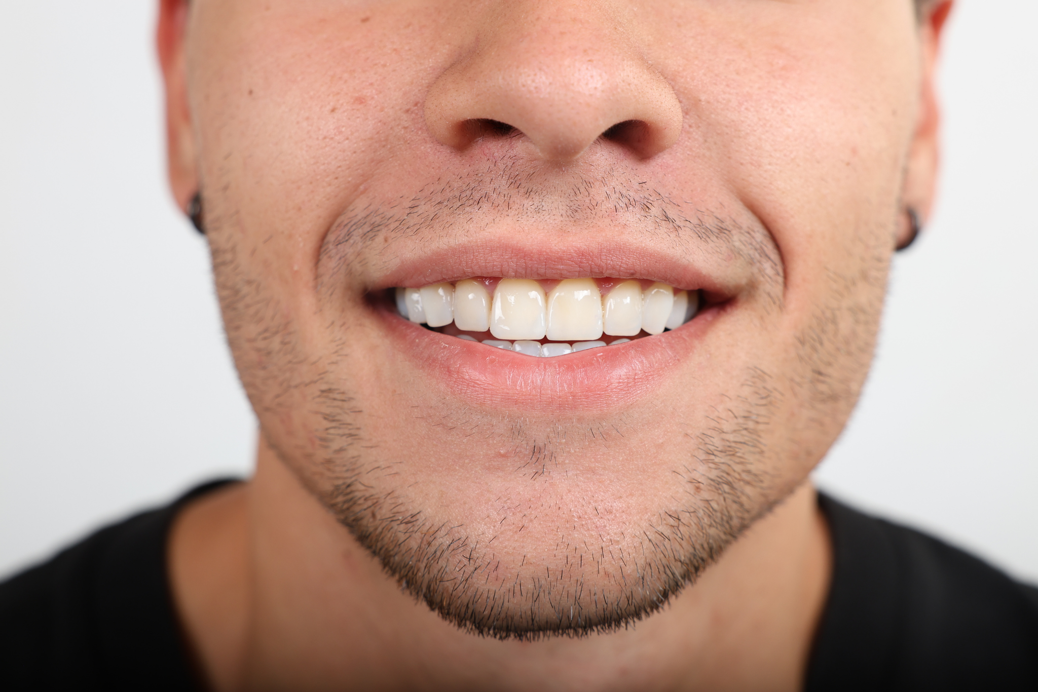 After E-max Veneer Treatment